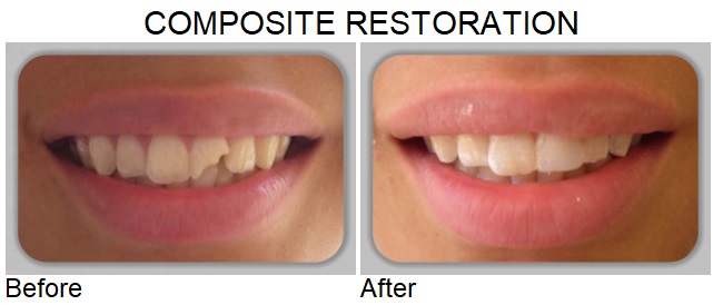 composite restoration