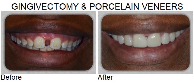 gingivectomy & porcelain vaneers
