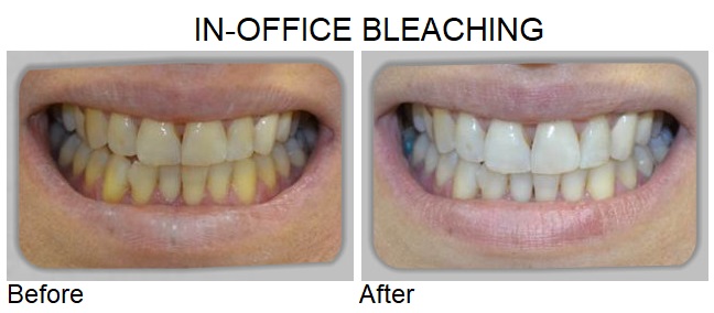 in-office bleaching
