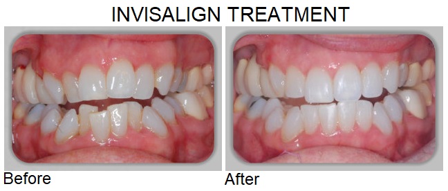 invisalign treatment