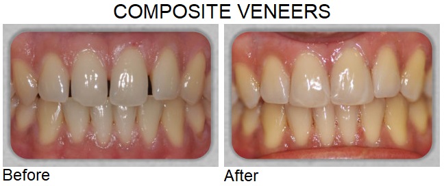 composite veneers