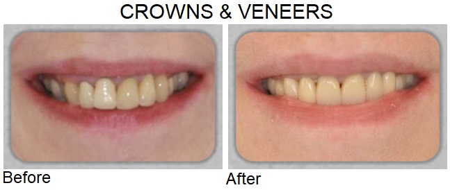 crowns & vaneers