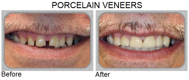 porcelain veneers