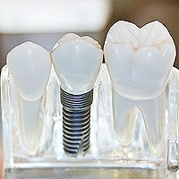 dental-implants-henderson-nv-dentist