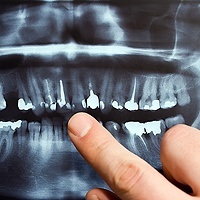full-mouth-reconstruction